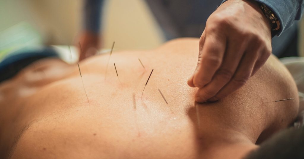 acupuncture vs dry needling