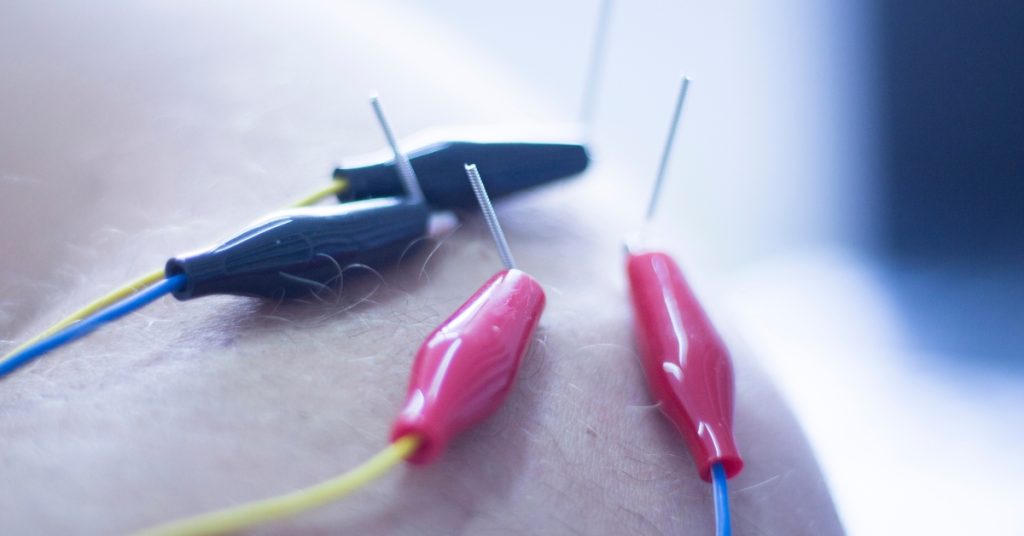 acupuncture vs dry needling