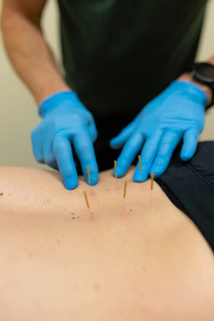 Is Dry Needling safe During Pregnancy?