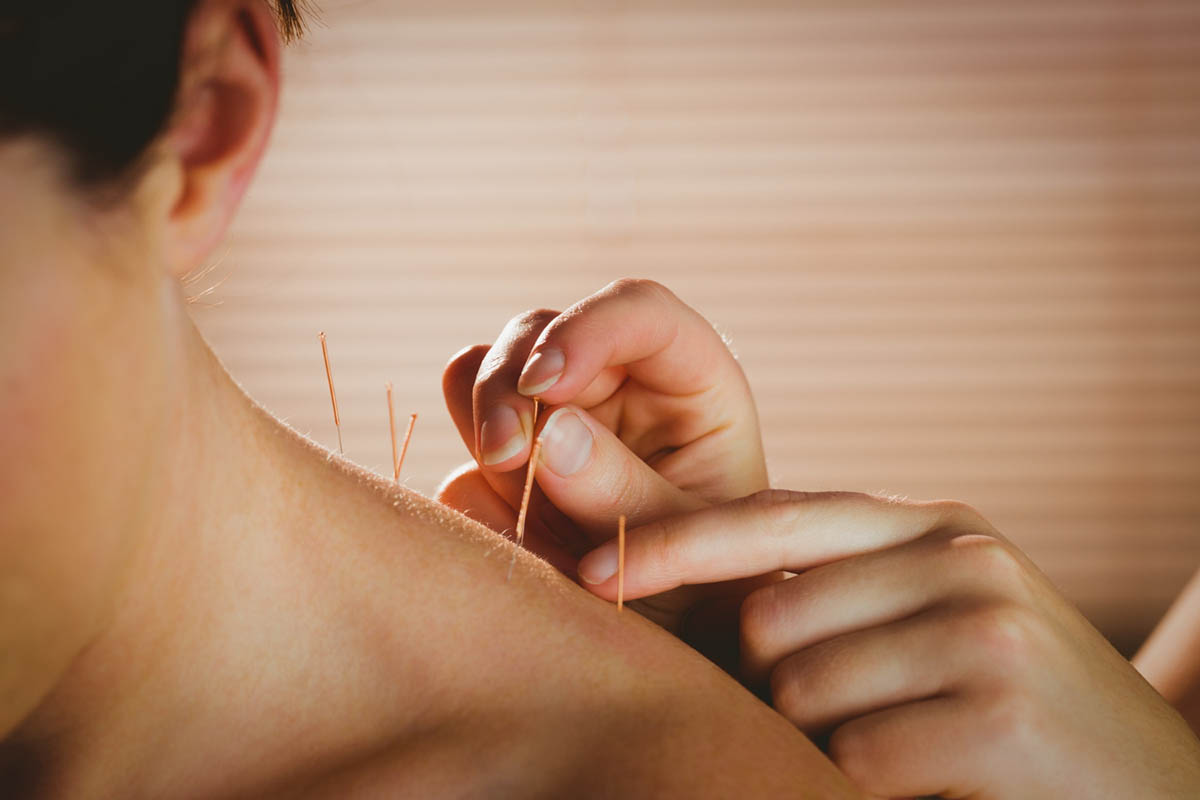 Does Dry Needling Hurt?
