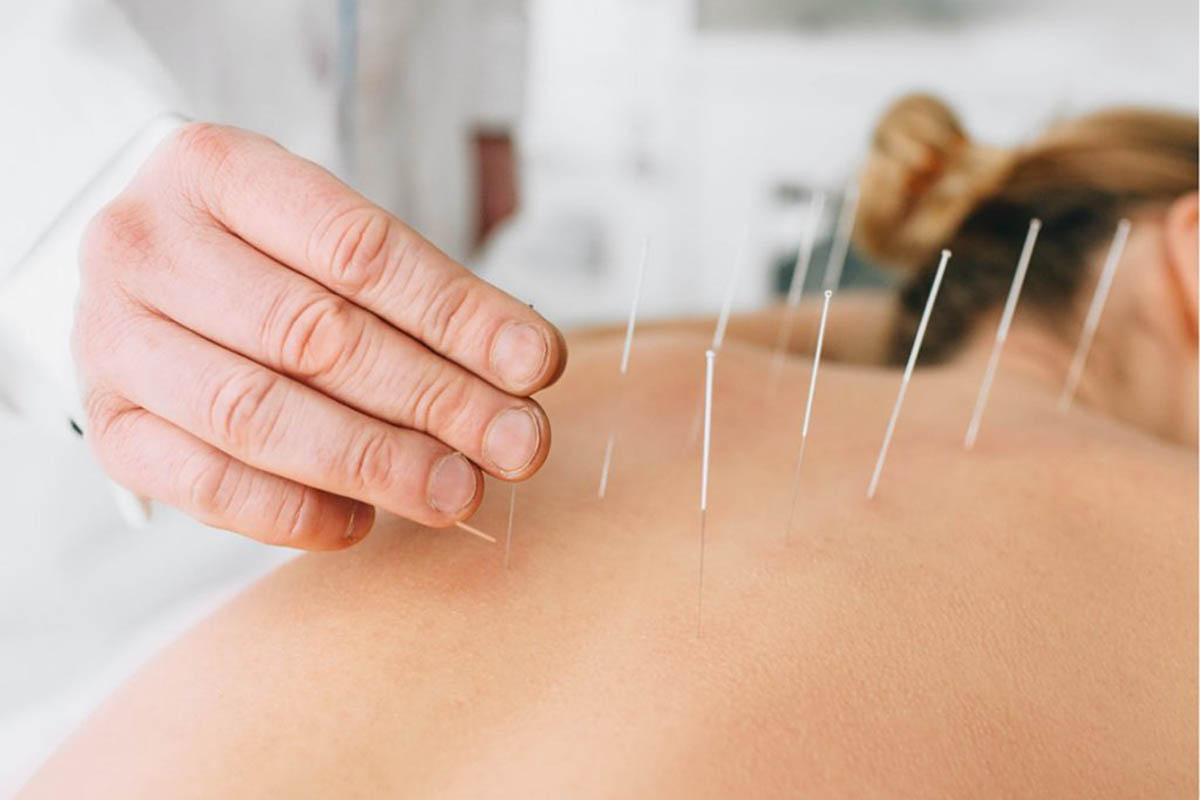 What to Expect During Dry Needling