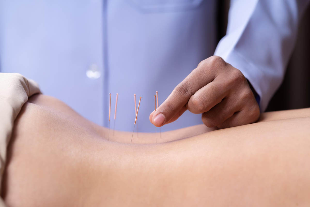 How to Find a Qualified Professional for Dry Needling