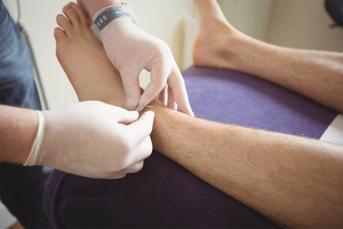 Dry Needling for Tendonitis: What You Need to Know