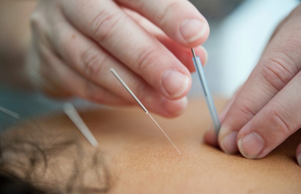 A woman getting acupuncture on her back. dry needling for migraines