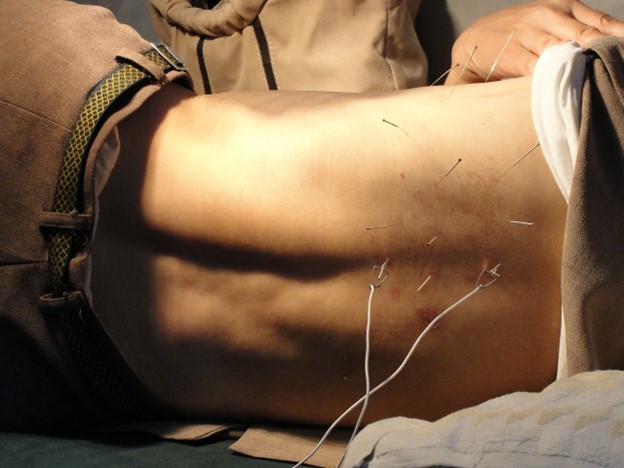 A person laying on a bed with acupuncture needles. dry needling migraine