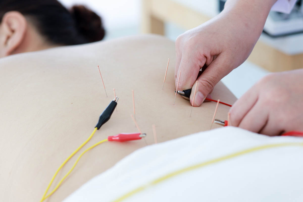 What to Know About Dry Needling With Electrical Stimulation